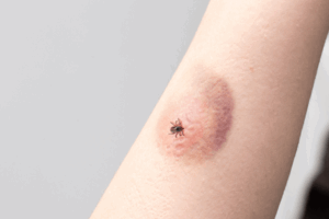Tick bite on the arm