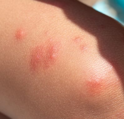 Bed bug bite on childs leg